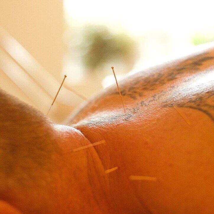 Man laid face down with acupuncture needles in back of neck and upper back.